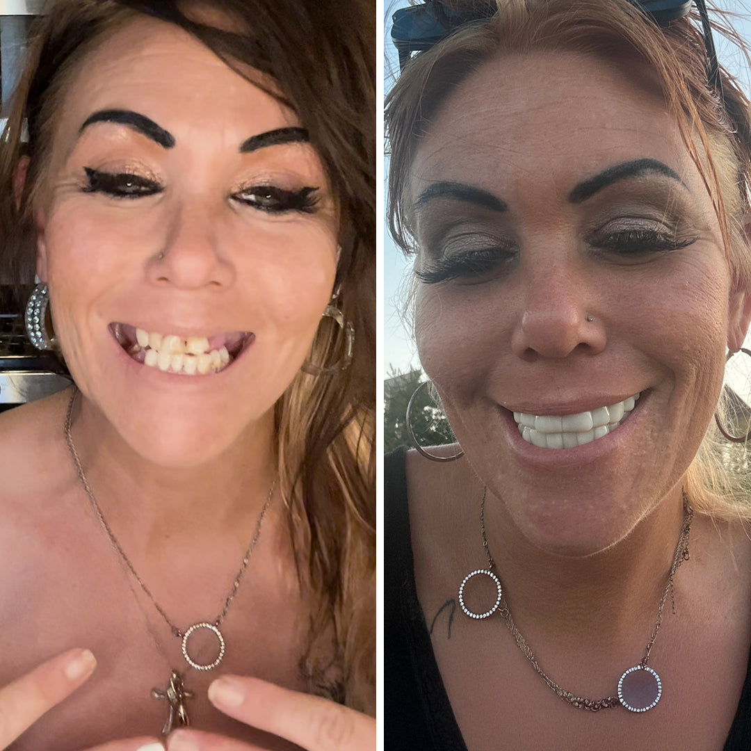 These veneers are a lifesaver