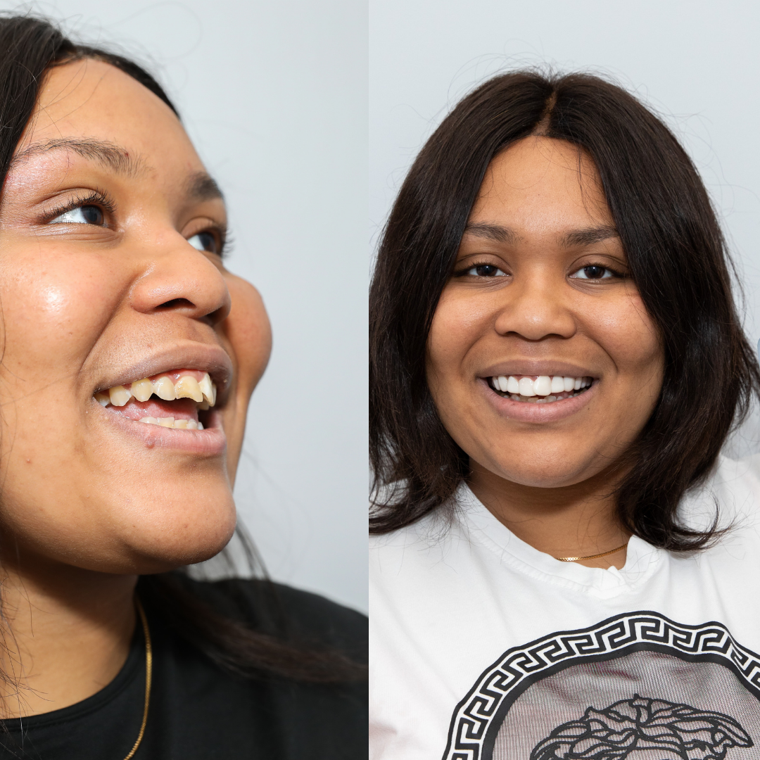 Bye Bye Chipped tooth