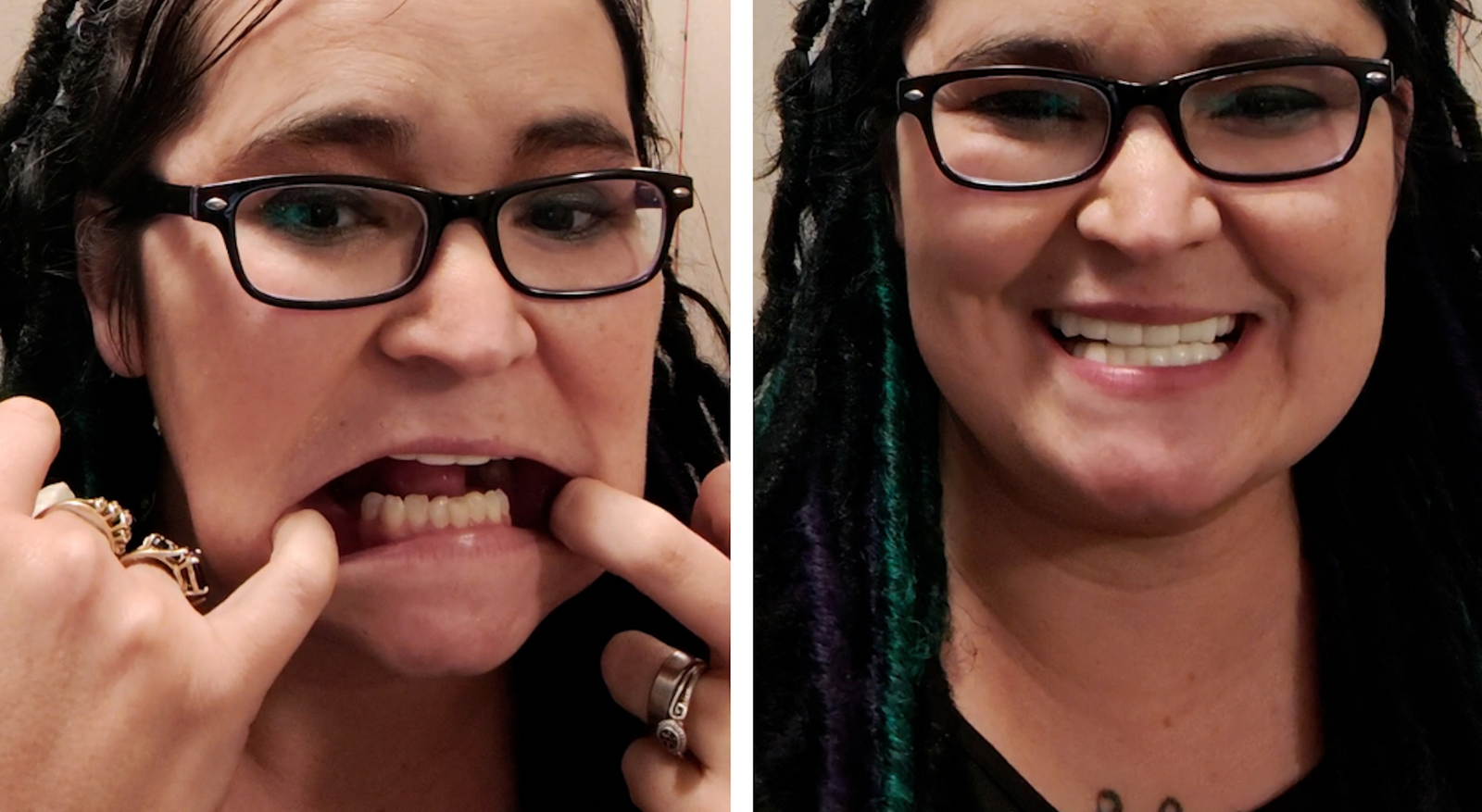 Look at the difference in my smile!