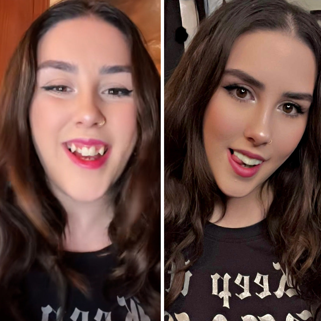 These veneers are CRAZY