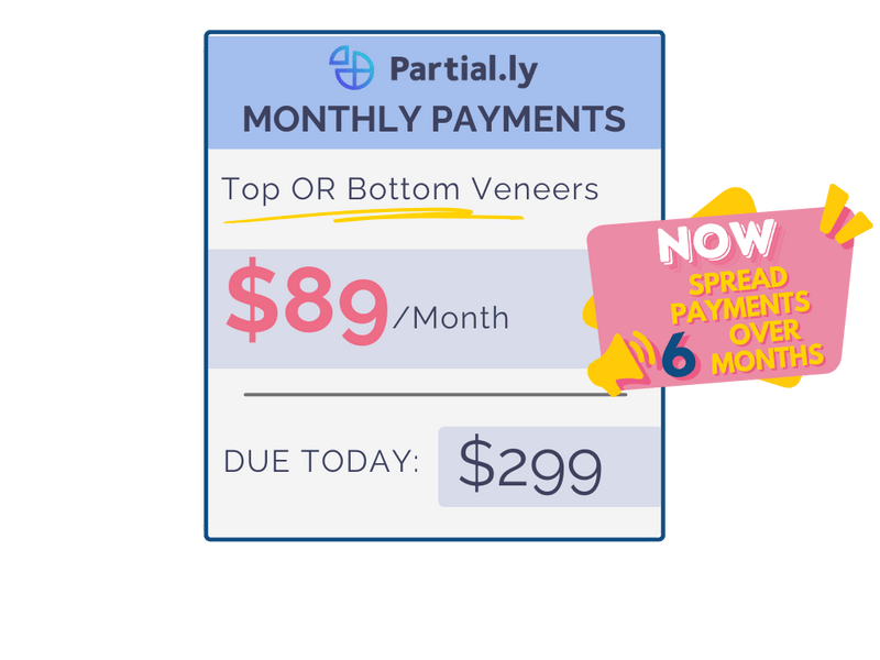 Monthly Payment Plan - Pop On Veneers with At Home Impression Kit