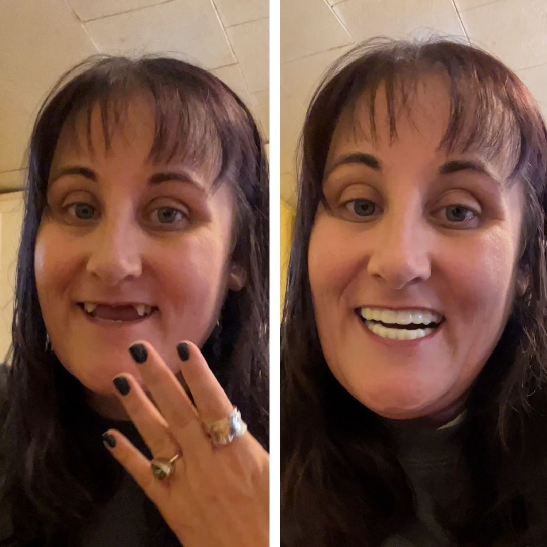 Ecstatic to have my smile back!