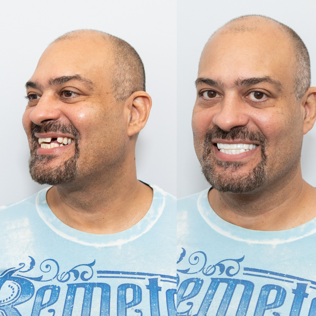 No More Flipper! No More Missing Teeth!