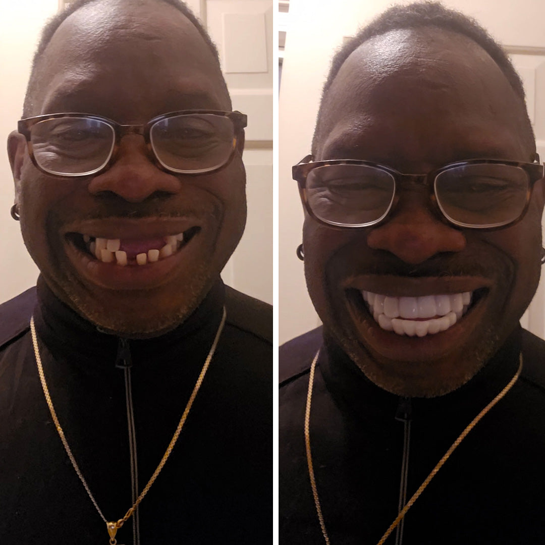 So glad I invested in my smile!