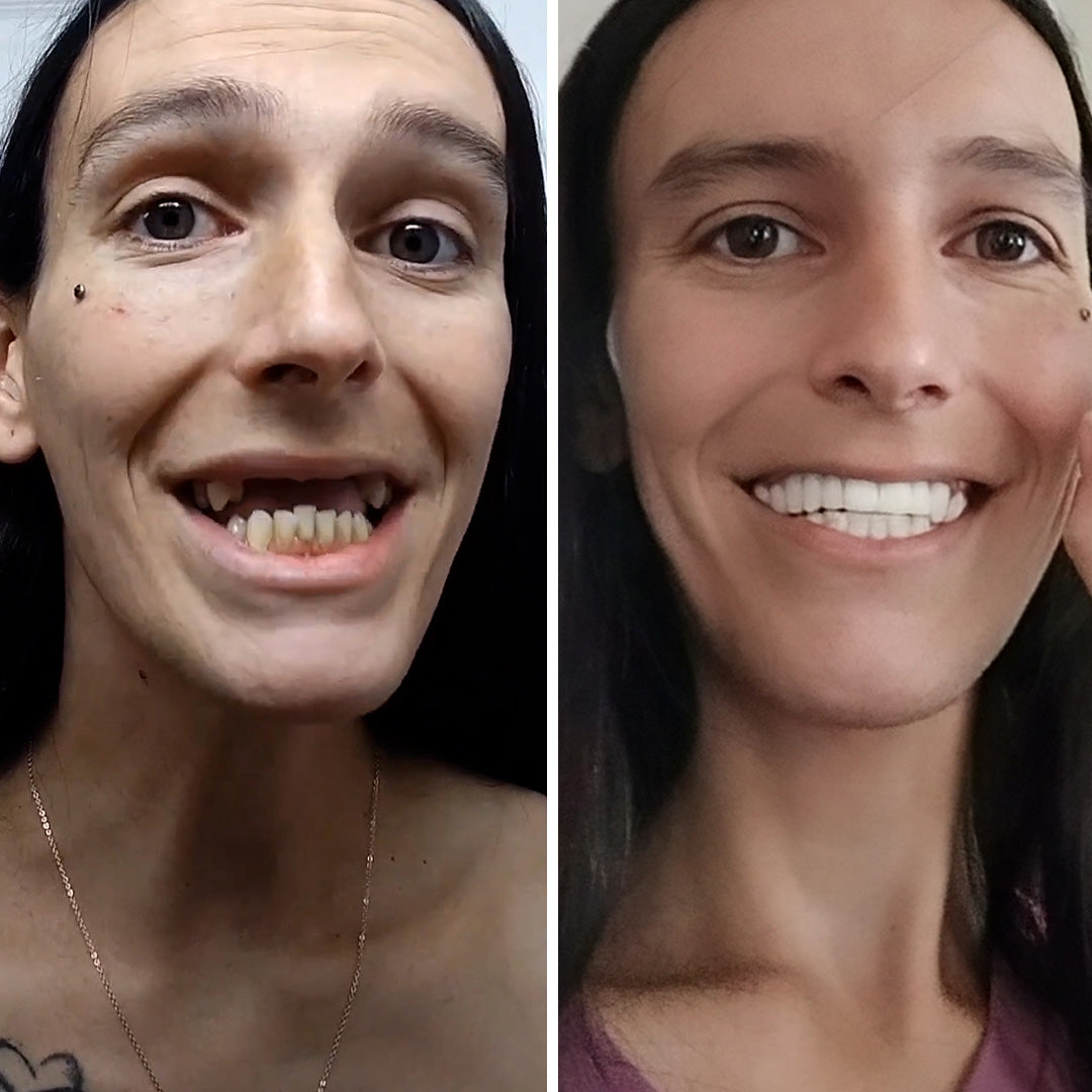 Night and day difference in my smile!