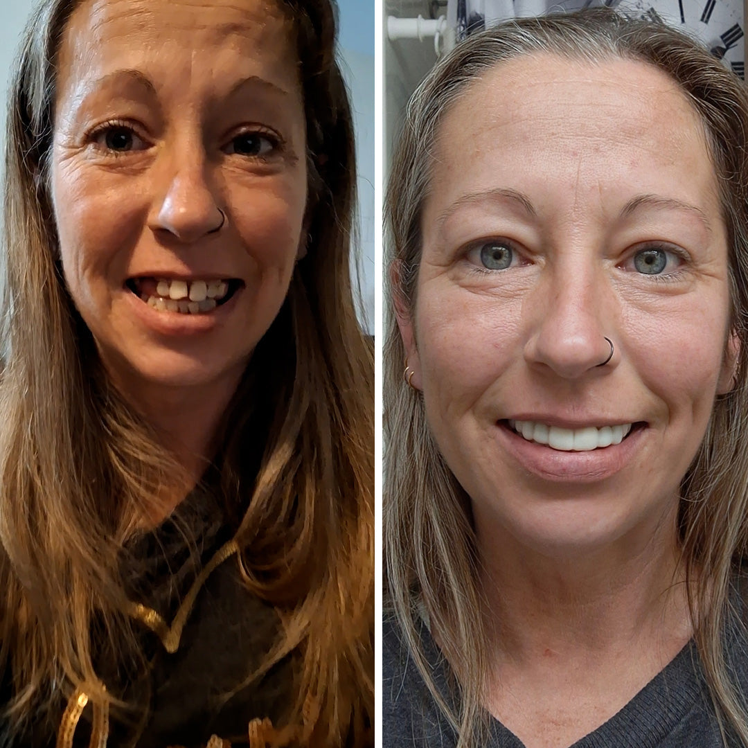 So easy to get my smile back!