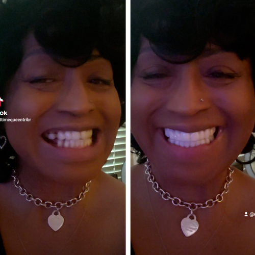 Don’t pay thousands for your smile!