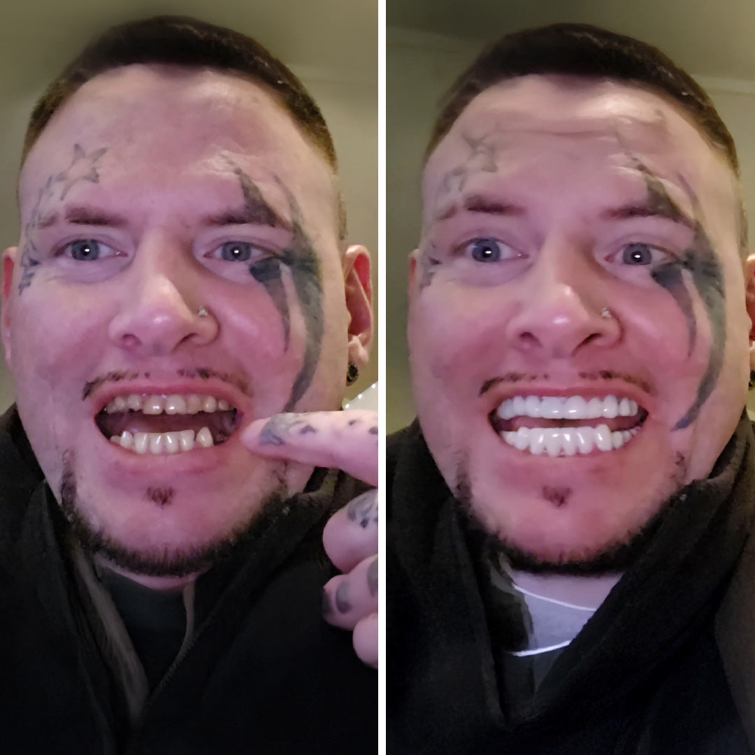 My veneers fit like a glove!