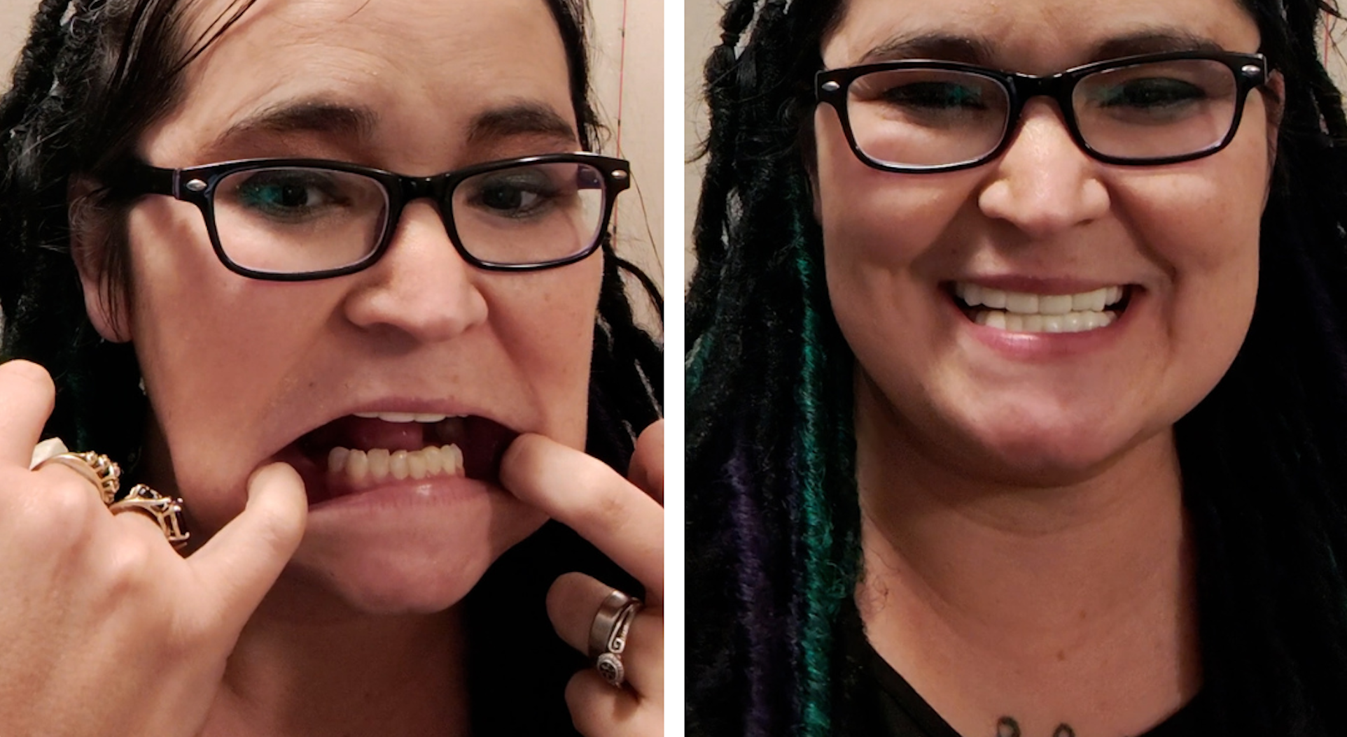 Look at the difference in my smile!