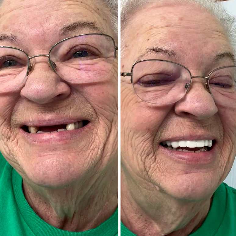 Get a full smile with Pop On Veneers!