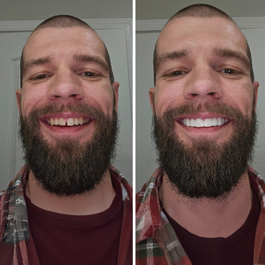 These veneers are LEGIT!